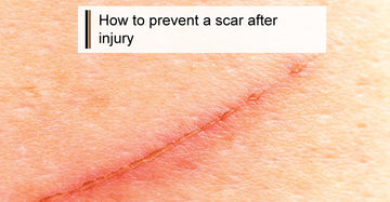 How to Prevent a Scar After an Injury
