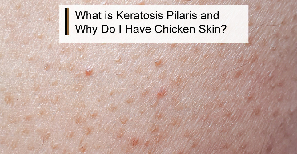 Chicken Skin Rasdh What is Keratosis Pilaris and Why Do I Have Chicken Skin?