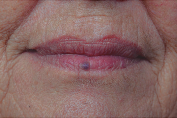 Venous Lake Treatment – For Blue Spot on Lip