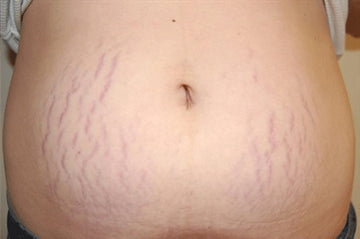 How To Prevent Stretch Marks During Pregnancy or Weight Gain