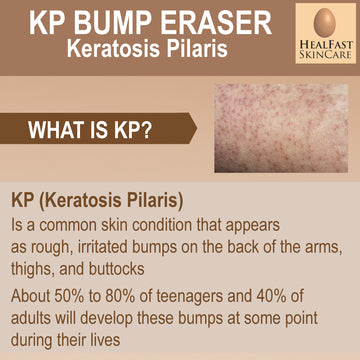 KP Bump Eraser Cream